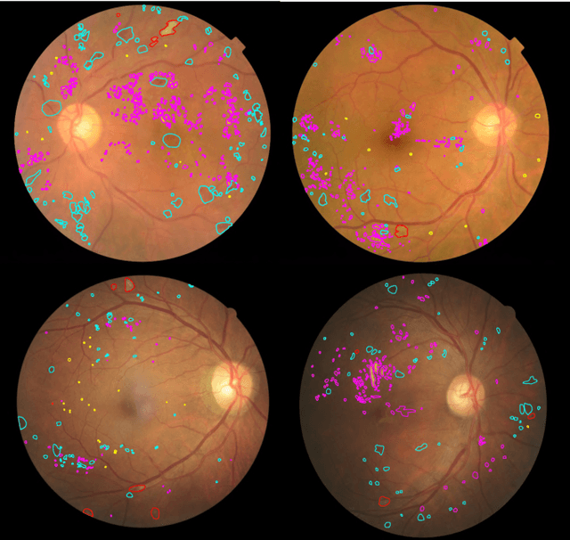 Figure 3 for DR-GAN: Conditional Generative Adversarial Network for Fine-Grained Lesion Synthesis on Diabetic Retinopathy Images