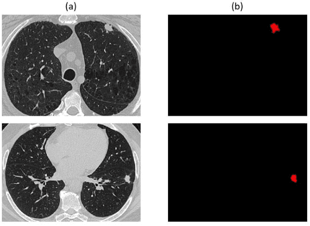 Figure 3 for Genotype-Guided Radiomics Signatures for Recurrence Prediction of Non-Small-Cell Lung Cancer