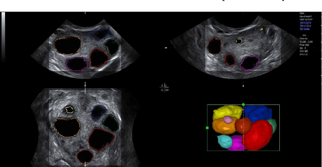 Figure 3 for The Ultrasound Visualization Pipeline - A Survey