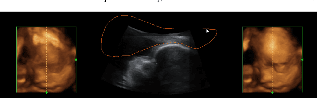 Figure 4 for The Ultrasound Visualization Pipeline - A Survey