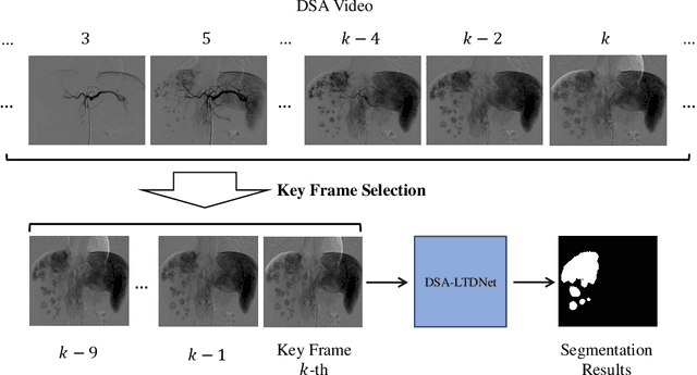 Figure 1 for Hepatocellular Carcinoma Segmentation fromDigital Subtraction Angiography Videos usingLearnable Temporal Difference
