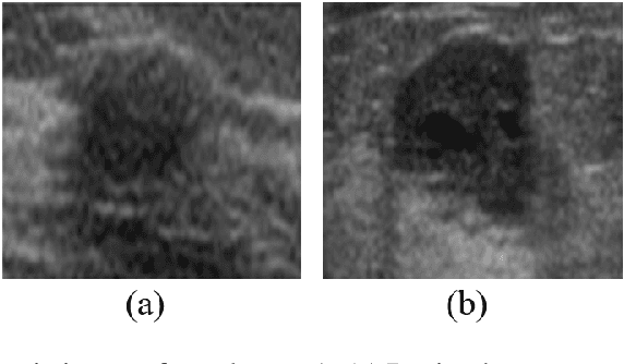 Figure 1 for Convolutional neural network based on transfer learning for breast cancer screening