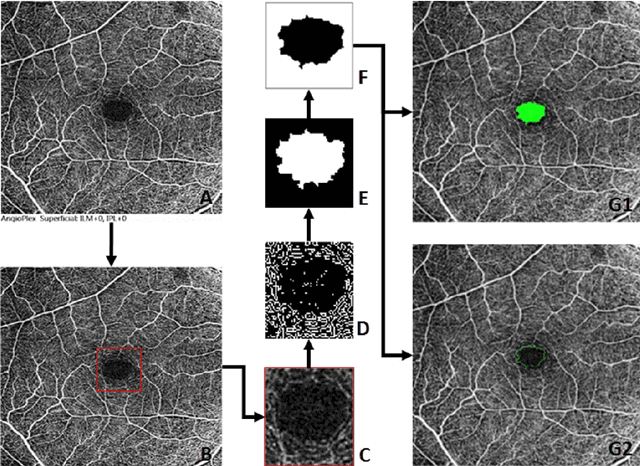 Figure 3 for FAZSeg: A New User-Friendly Software for Quantification of the Foveal Avascular Zone