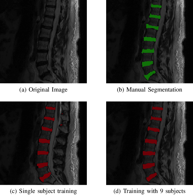 Figure 4 for Extreme Augmentation : Can deep learning based medical image segmentation be trained using a single manually delineated scan?