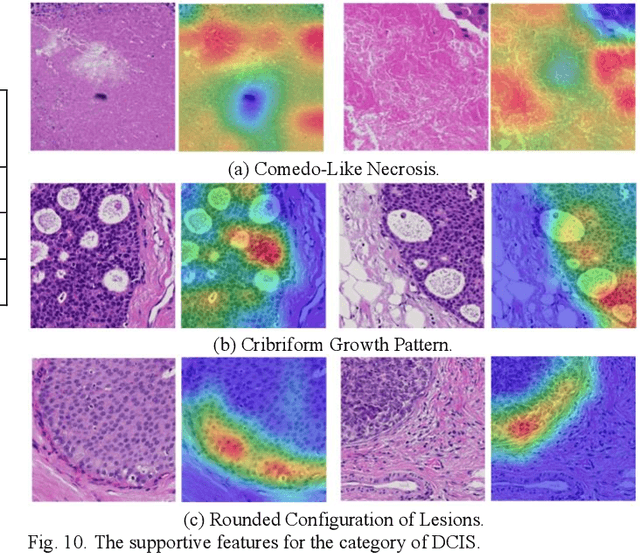 Figure 2 for A Computer-Aided Diagnosis System for Breast Pathology: A Deep Learning Approach with Model Interpretability from Pathological Perspective