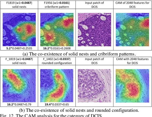 Figure 4 for A Computer-Aided Diagnosis System for Breast Pathology: A Deep Learning Approach with Model Interpretability from Pathological Perspective