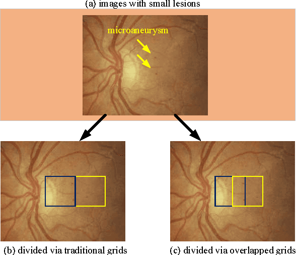 Figure 2 for Lesion detection and Grading of Diabetic Retinopathy via Two-stages Deep Convolutional Neural Networks