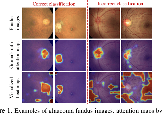 Figure 1 for Attention Based Glaucoma Detection: A Large-scale Database and CNN Model