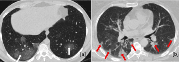 Figure 1 for COVID-Rate: An Automated Framework for Segmentation of COVID-19 Lesions from Chest CT Scans