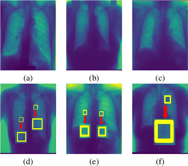 Figure 3 for Informative sample generation using class aware generative adversarial networks for classification of chest Xrays