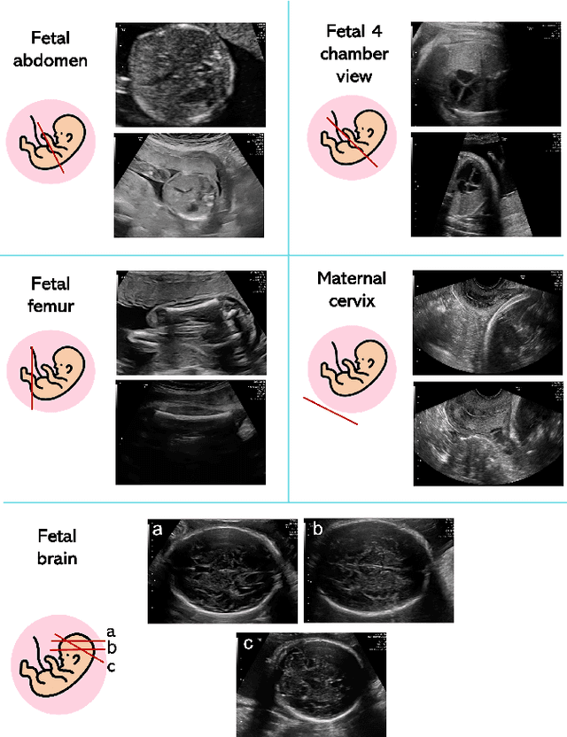 Figure 4 for A Review on Deep-Learning Algorithms for Fetal Ultrasound-Image Analysis