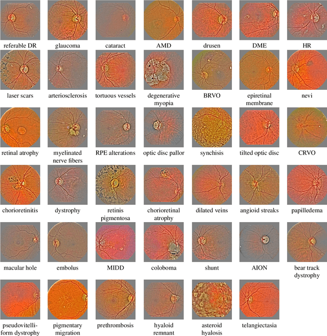 Figure 3 for Automatic detection of multiple pathologies in fundus photographs using spin-off learning