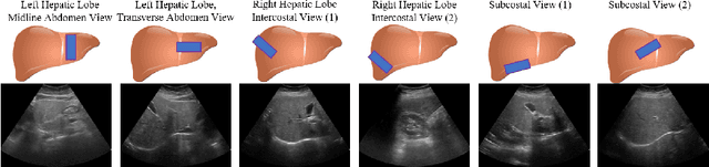 Figure 4 for Reliable Liver Fibrosis Assessment from Ultrasound using Global Hetero-Image Fusion and View-Specific Parameterization