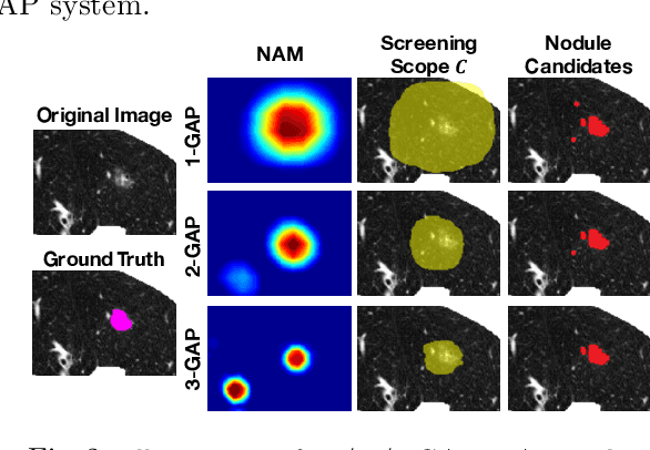 Figure 3 for Discriminative Localization in CNNs for Weakly-Supervised Segmentation of Pulmonary Nodules