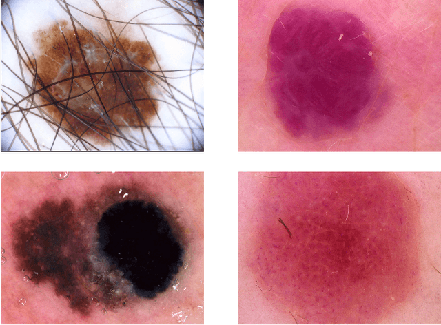 Figure 1 for Skin cancer detection based on deep learning and entropy to detect outlier samples