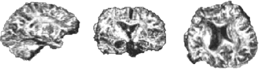 Figure 1 for Prediction of Epilepsy Development in Traumatic Brain Injury Patients from Diffusion Weighted MRI