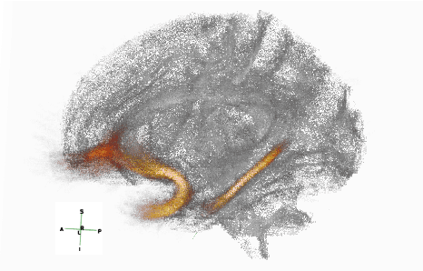 Figure 3 for Prediction of Epilepsy Development in Traumatic Brain Injury Patients from Diffusion Weighted MRI