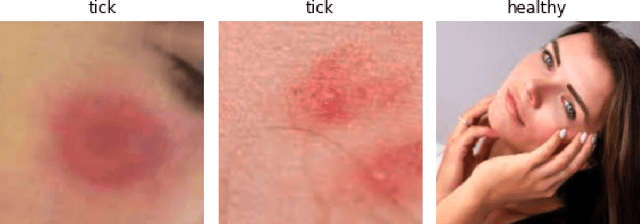 Figure 4 for Automatic Detection and Classification of Tick-borne Skin Lesions using Deep Learning