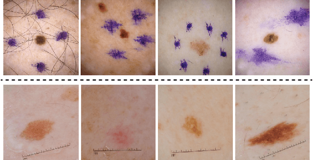 Figure 1 for Skin Deep Unlearning: Artefact and Instrument Debiasing in the Context of Melanoma Classification