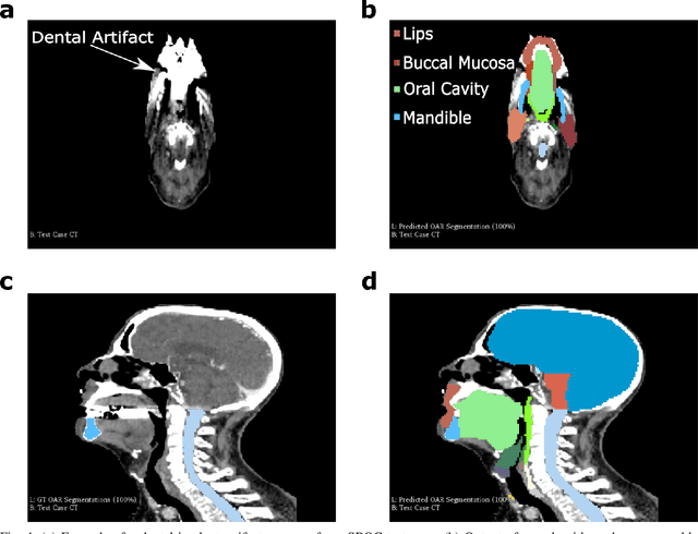 Figure 4 for Atlas Based Segmentations via Semi-Supervised Diffeomorphic Registrations