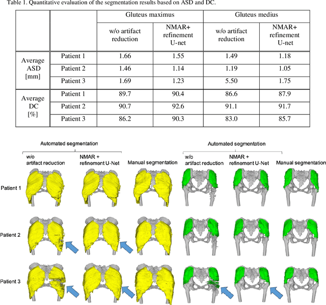 Figure 2 for Automated Segmentation of Hip and Thigh Muscles in Metal Artifact-Contaminated CT using Convolutional Neural Network-Enhanced Normalized Metal Artifact Reduction