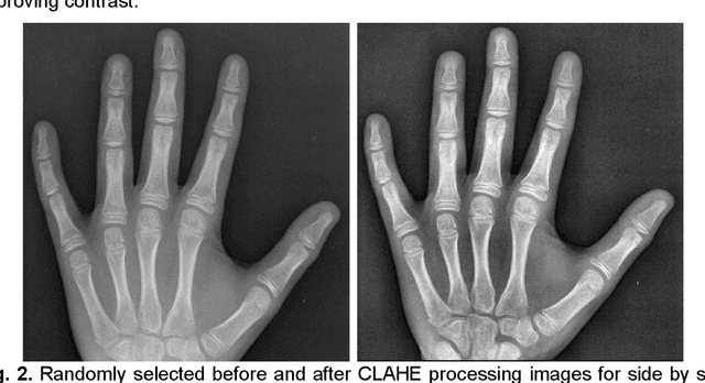 Figure 3 for Rheumatoid Arthritis: Automated Scoring of Radiographic Joint Damage