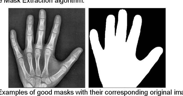 Figure 4 for Rheumatoid Arthritis: Automated Scoring of Radiographic Joint Damage