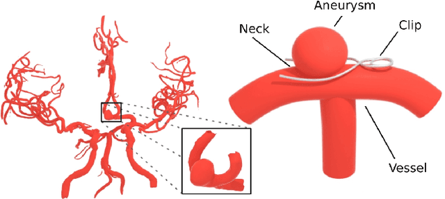 Figure 2 for IntrA: 3D Intracranial Aneurysm Dataset for Deep Learning