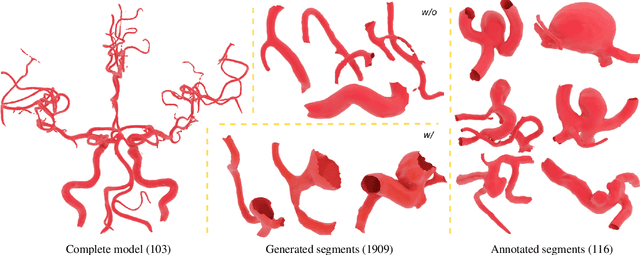 Figure 4 for IntrA: 3D Intracranial Aneurysm Dataset for Deep Learning
