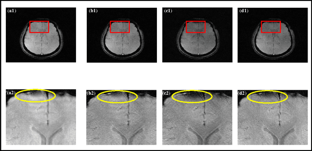 Figure 4 for Higher dimensional homodyne filtering for suppression of incidental phase artifacts in multichannel MRI