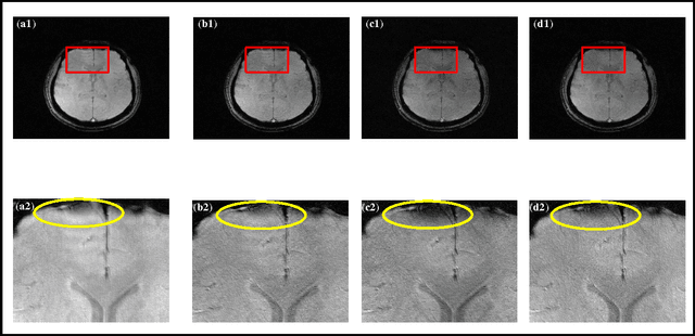 Figure 4 for Higher dimensional homodyne filtering for suppression of incidental phase artifacts in multichannel MRI