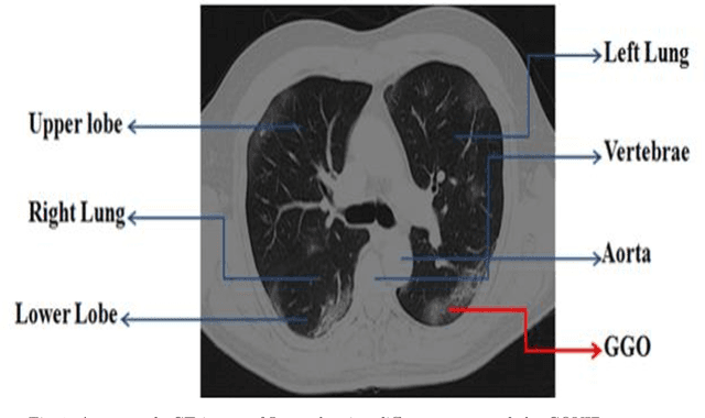Figure 1 for A review of Deep learning Techniques for COVID-19 identification on Chest CT images