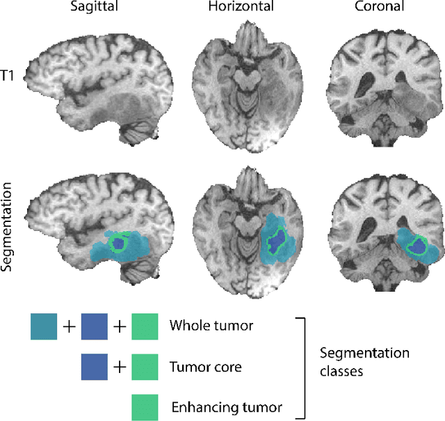 Figure 4 for Memory efficient brain tumor segmentation using an autoencoder-regularized U-Net