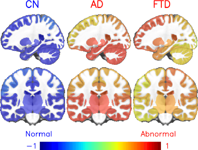 Figure 4 for Interpretable differential diagnosis for Alzheimer's disease and Frontotemporal dementia