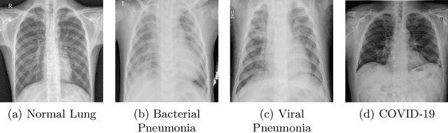 Figure 1 for CovidAID: COVID-19 Detection Using Chest X-Ray