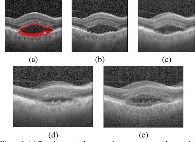 Figure 1 for Pathological Retinal Region Segmentation From OCT Images Using Geometric Relation Based Augmentation