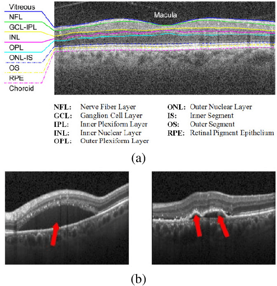 Figure 3 for Pathological Retinal Region Segmentation From OCT Images Using Geometric Relation Based Augmentation