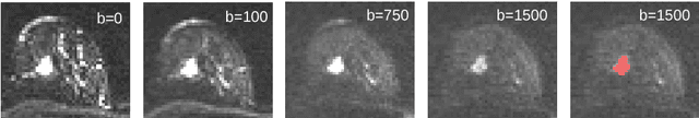 Figure 1 for Revealing Hidden Potentials of the q-Space Signal in Breast Cancer