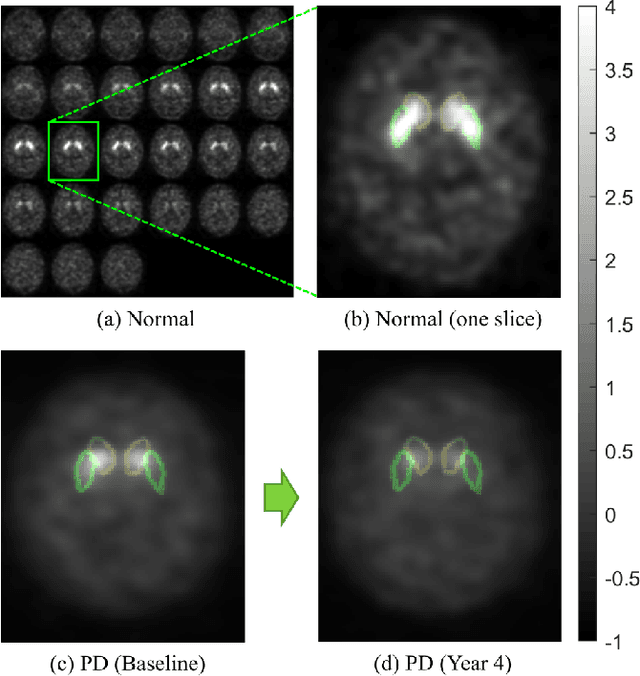 Figure 1 for Self-normalized Classification of Parkinson's Disease DaTscan Images