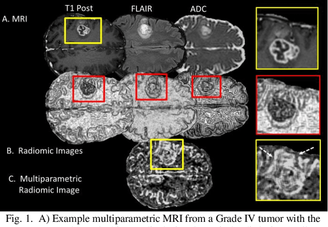 Figure 1 for Multiparametric Deep Learning and Radiomics for Tumor Grading and Treatment Response Assessment of Brain Cancer: Preliminary Results