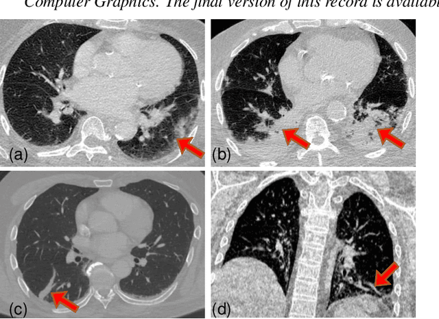 Figure 1 for COVID-view: Diagnosis of COVID-19 using Chest CT