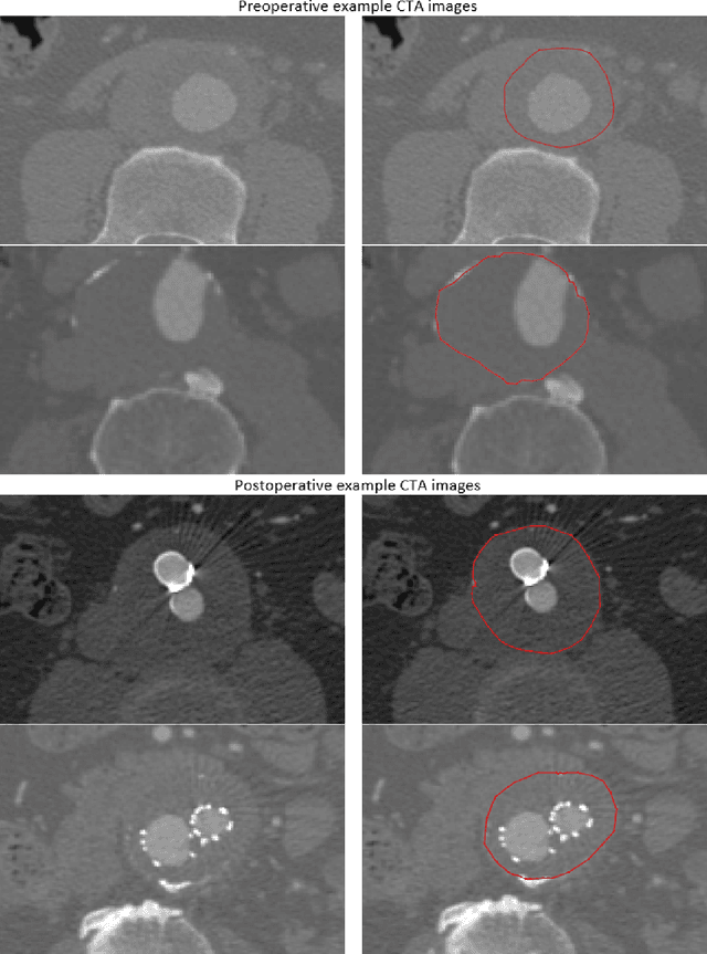Figure 1 for 3D convolutional neural network for abdominal aortic aneurysm segmentation