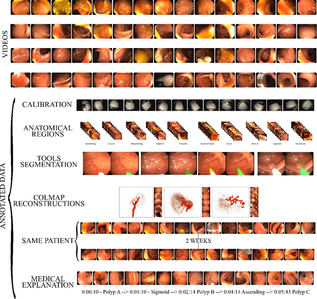 Figure 1 for EndoMapper dataset of complete calibrated endoscopy procedures