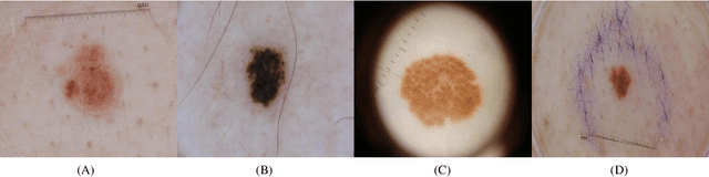 Figure 4 for The Fast and Accurate Approach to Detection and Segmentation of Melanoma Skin Cancer using Fine-tuned Yolov3 and SegNet Based on Deep Transfer Learning