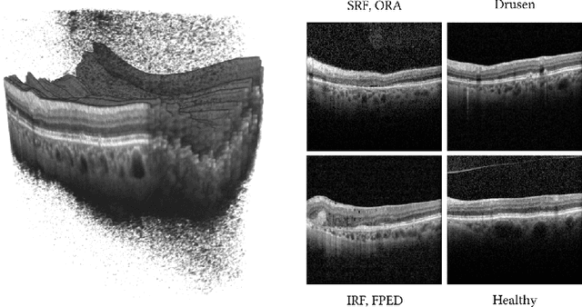 Figure 1 for Fused Detection of Retinal Biomarkers in OCT Volumes