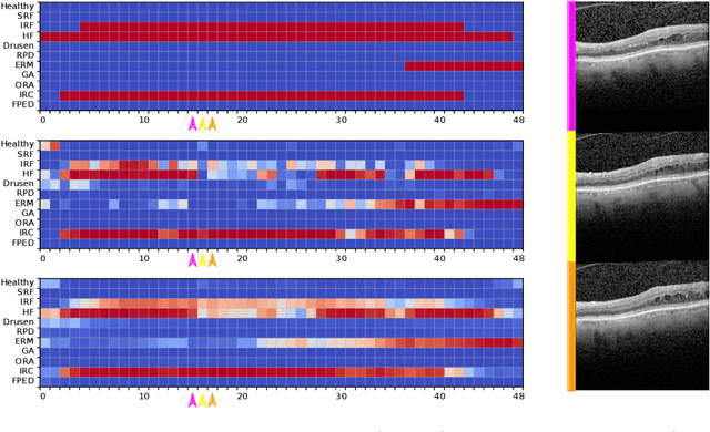 Figure 4 for Fused Detection of Retinal Biomarkers in OCT Volumes