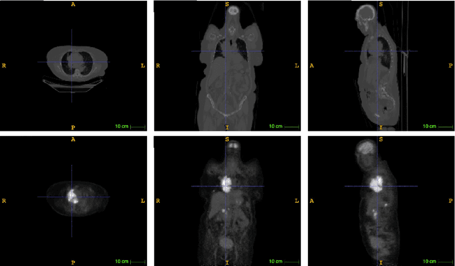 Figure 3 for Lymphoma segmentation from 3D PET-CT images using a deep evidential network