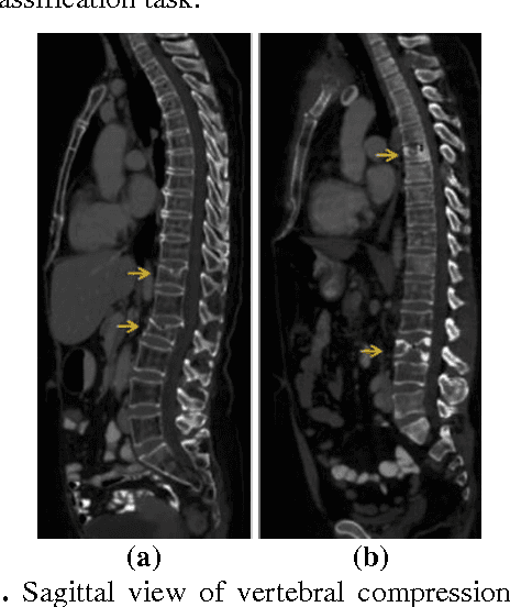 Figure 1 for Osteoporotic and Neoplastic Compression Fracture Classification on Longitudinal CT