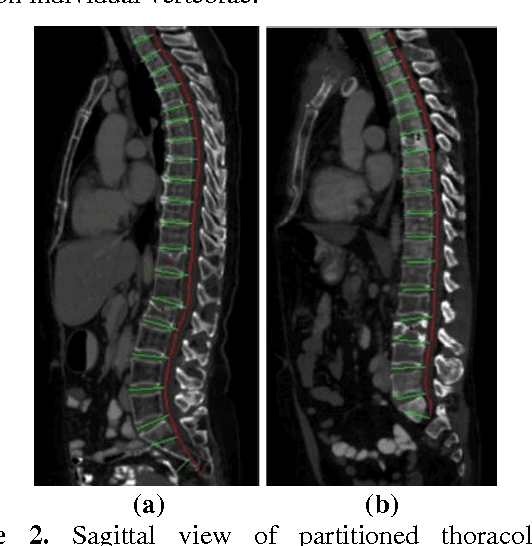 Figure 3 for Osteoporotic and Neoplastic Compression Fracture Classification on Longitudinal CT