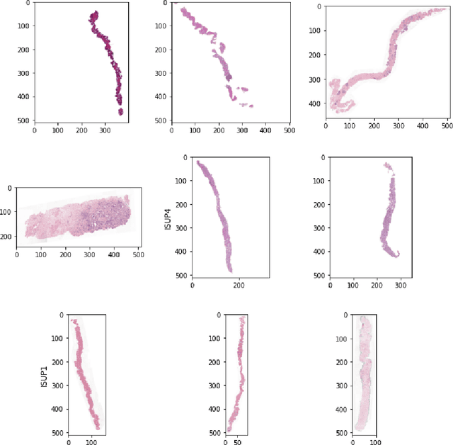 Figure 1 for Automated Prostate Cancer Diagnosis Based on Gleason Grading Using Convolutional Neural Network